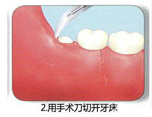 智齿一定要拔吗 了解牙医是怎么拔智齿的