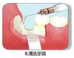 智齿一定要拔吗 了解牙医是怎么拔智齿的