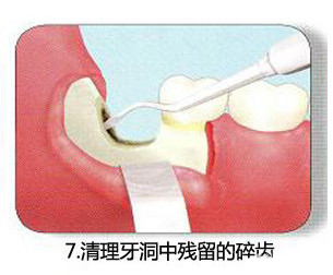 智齿一定要拔吗 了解牙医是怎么拔智齿的