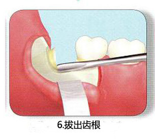 智齿一定要拔吗 了解牙医是怎么拔智齿的