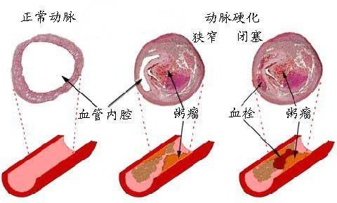 心肌缺血的症状 心肌缺血的食疗方法