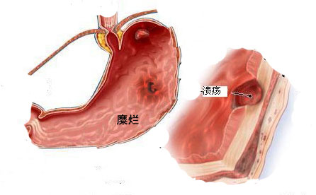 胃溃疡病人如何防止胃癌发生