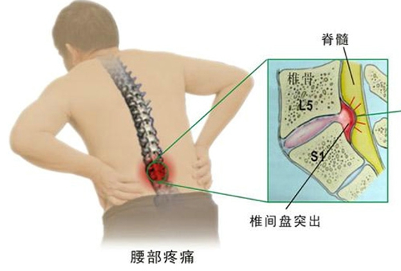 腰椎间盘突出禁忌 忌吃辛辣刺激忌烟酒