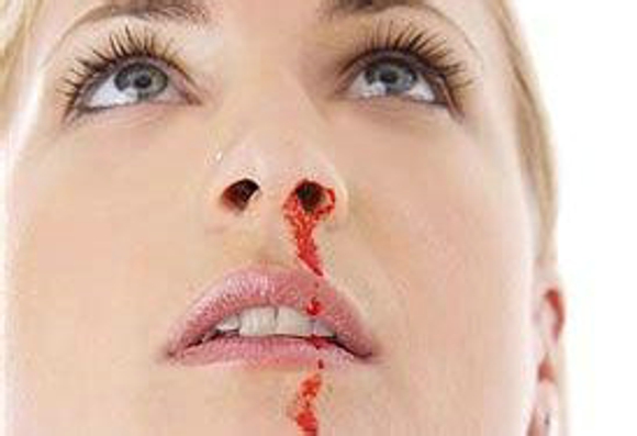 流鼻血是什么原因 刺一根针立马止血
