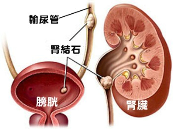 肾结石能吃海带吗 了解肾结石的症状