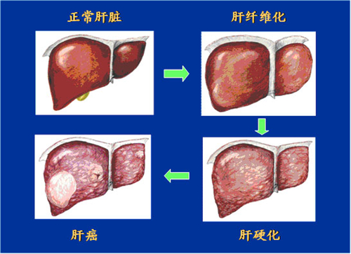 肝硬化的症状 肝硬化患者要这样吃