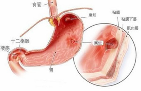 肠胃炎的症状 这么治疗肠胃炎好得快