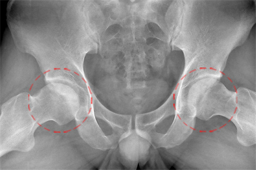 股骨头坏死症状 股骨头坏死应该这样治疗