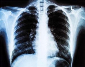 肺癌晚期能活多久 小心这几件事都会引起肺癌