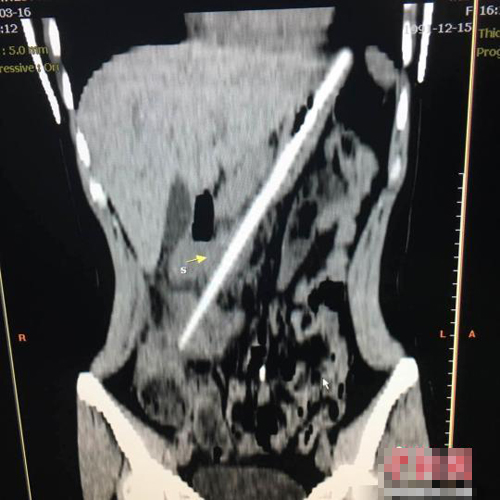 女子“生吞”24厘米筷子 3月后才取出