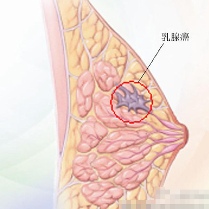 35岁未婚女青年乳房流出“乳汁” 确诊得癌症(3)