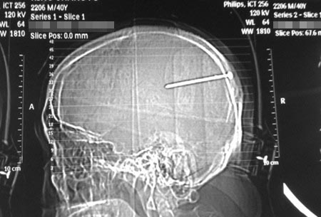 女子脑内一枚5厘米钢钉＂寄宿＂40年 致癫痫频发(4)