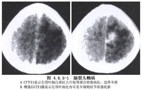 19岁小伙大脑里游着一条寄生虫 医生：喝凉水易感染(4)