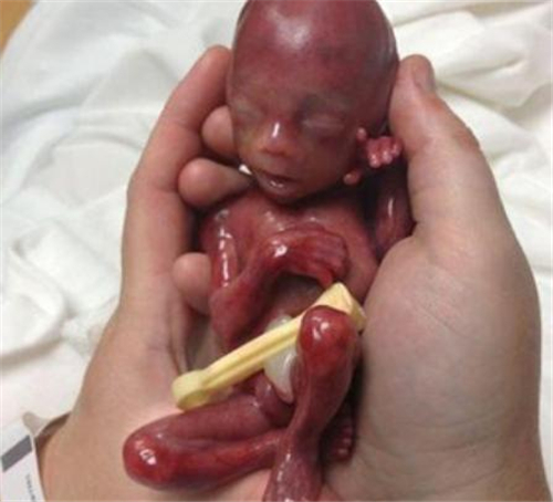 慎入！女子怀孕19周就生下小过手掌的婴儿