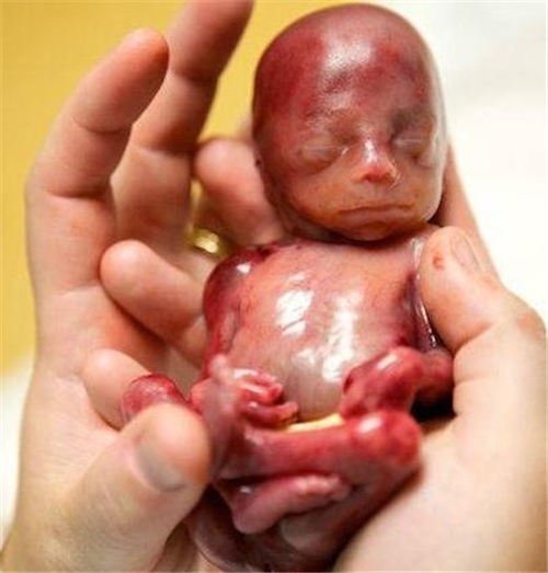 慎入！女子怀孕19周就生下小过手掌的婴儿(3)