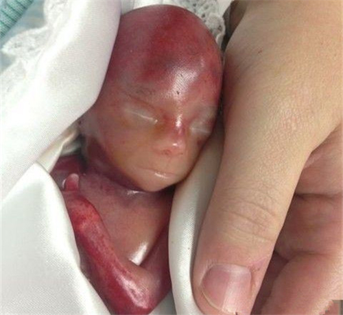 慎入！女子怀孕19周就生下小过手掌的婴儿(2)