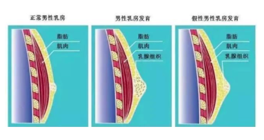 男性胸部很大是怎么回事